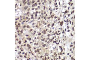 Immunohistochemistry of paraffin-embedded human lung cancer using CHEK2 antibody.