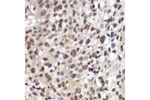Immunohistochemistry of paraffin-embedded human lung cancer using CHEK2 antibody. (CHEK2 anticorps  (AA 1-220))