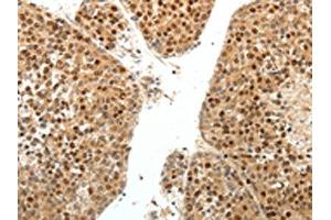 The image on the left is immunohistochemistry of paraffin-embedded Human liver cancer tissue using ABIN7131160(SPATA2L Antibody) at dilution 1/30, on the right is treated with fusion protein. (SPATA2L anticorps)