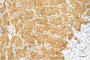 Immunohistochemistry was performed on paraffin-embedded human hepatocarcinoma using arginase 1 antibody (ABIN7797643), 1:200). (Recombinant Liver Arginase anticorps)