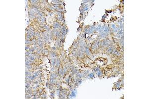 Immunohistochemistry of paraffin-embedded human colon carcinoma using SLC8 Rabbit pAb (ABIN6132664, ABIN6148050, ABIN6148052 and ABIN6221228) at dilution of 1:100 (40x lens). (SLC8A1 anticorps  (AA 250-520))
