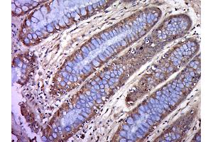 Formalin-fixed and paraffin embedded human colon cancer labeled with BTN2A1 Polyclonal Antibody, Unconjugated (bs-20473R) at 1:200, followed by conjugation to the secondary antibody and DAB staining