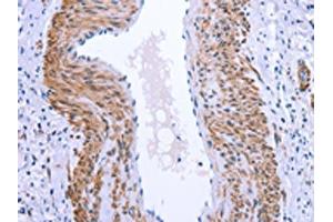 The image on the left is immunohistochemistry of paraffin-embedded Human cervical cancer tissue using ABIN7190847(GPR171 Antibody) at dilution 1/25, on the right is treated with synthetic peptide. (GPR171 anticorps)
