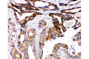 Anti-DCC antibody, IHC(P) IHC(P): Human Intestinal Cancer Tissue (DCC anticorps  (N-Term))