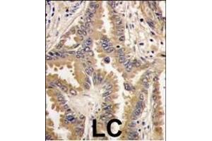 Formalin-fixed and paraffin-embedded human lung carcinoma tissue reacted with Bad antibody (Center), which was peroxidase-conjugated to the secondary antibody, followed by DAB staining.