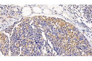 Detection of EIF4EBP1 in Human Breast cancer Tissue using Polyclonal Antibody to Eukaryotic Translation Initiation Factor 4E Binding Protein 1 (EIF4EBP1)