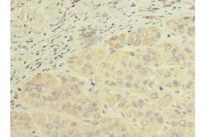 Immunohistochemistry of paraffin-embedded human liver cancer using ABIN7168643 at dilution of 1:100 (SCFD2 anticorps  (AA 255-470))