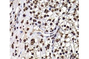 Immunohistochemistry of paraffin-embedded Human kidney cancer using DNAJB6 Polyclonal Antibody at dilution of 1:100 (40x lens).