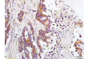 Formalin-fixed and paraffin embedded human colon carcinoma labeled with Rabbit Anti-TIMP-1(NT) Polyclonal Antibody, Unconjugated at 1:200 followed by conjugation to the secondary antibody and DAB staining.