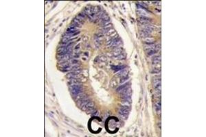 Formalin-fixed and paraffin-embedded human colon carcinoma tissue reacted with PTPH1 antibody (Center), which was peroxidase-conjugated to the secondary antibody, followed by DAB staining.
