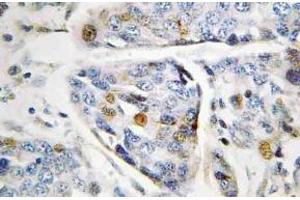 Immunohistochemistry (IHC) analyzes of Lamin A antibody in paraffin-embedded human breast carcinoma tissue. (Lamin A/C anticorps)