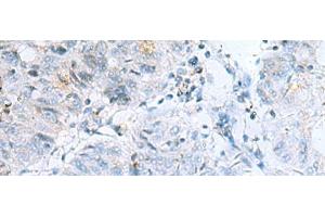 Immunohistochemistry of paraffin-embedded Human colorectal cancer tissue using POMC Polyclonal Antibody at dilution of 1:35(x200) (POMC anticorps)