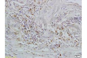 Formalin-fixed and paraffin embedded human rectal carcinoma tissue labeled with Rabbit Anti-GPR30 Polyclonal Antibody (ABIN685717) at 1:200 followed by conjugation to the secondary antibody and DAB staining.