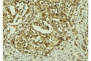 ABIN6273150 at 1/100 staining Human breast cancer tissue by IHC-P. (PRPF8 anticorps  (C-Term))