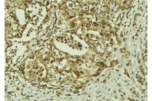 ABIN6273150 at 1/100 staining Human breast cancer tissue by IHC-P.