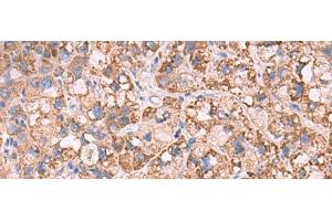 Immunohistochemistry of paraffin-embedded Human liver cancer tissue using KCNN1 Polyclonal Antibody at dilution of 1:55(x200) (KCNN1 anticorps)