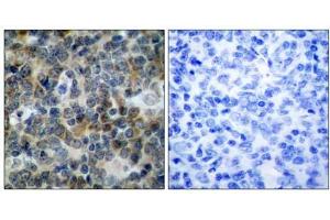 Immunohistochemical analysis of paraffin-embedded human tonsil carcinoma tissue, using VASP (phospho-Ser238) antibody (E011158).
