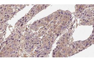 ABIN6276716 at 1/100 staining Human liver cancer tissue by IHC-P. (CD4 anticorps  (C-Term))