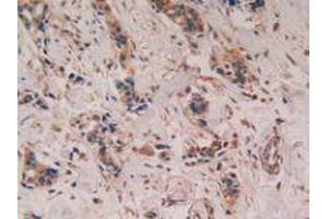 IHC-P analysis of Human Breast Cancer Tissue, with DAB staining. (PTGS2 anticorps  (AA 418-589))