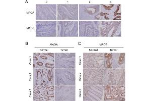 Immunohistochemical (IHC) results of monoamine oxidase A (MAOA) and MAOB expressions in a Taiwanese colorectal cancer cohort. (Monoamine Oxidase A anticorps  (Center))