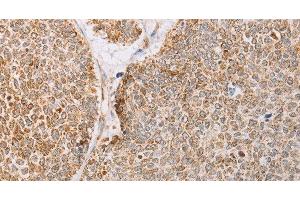 Immunohistochemistry of paraffin-embedded Human lung cancer tissue using YARS2 Polyclonal Antibody at dilution 1:30 (YARS2 anticorps)