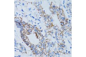Immunohistochemistry of paraffin-embedded human colon carcinoma using LGALS8 antibody. (LGALS8 anticorps)