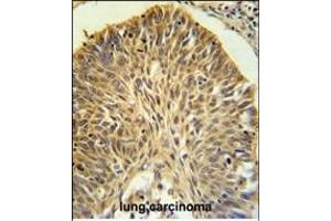 LRG1 Antibody (N-term) (ABIN652229 and ABIN2840955) IHC analysis in formalin fixed and paraffin embedded lung carcinoma followed by peroxidase conjugation of the secondary antibody and DAB staining.