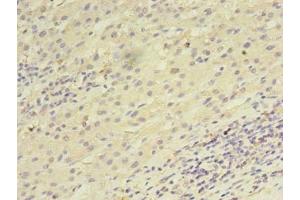 Immunohistochemistry of paraffin-embedded human liver cancer using ABIN7168458 at dilution of 1:100 (UTP23 anticorps  (AA 1-249))
