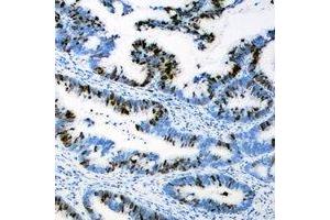 Immunohistochemical analysis of AEBP2 staining in human colon cancer formalin fixed paraffin embedded tissue section.