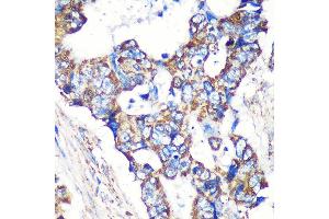 Immunohistochemistry of paraffin-embedded Human colon carcinoma using STNL Rabbit pAb (ABIN7270585) at dilution of 1:100 (40x lens). (STARD3NL anticorps  (AA 185-234))