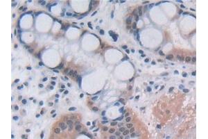 Detection of OAS2 in Human Stomach cancer Tissue using Polyclonal Antibody to 2',5'-Oligoadenylate Synthetase 2 (OAS2)