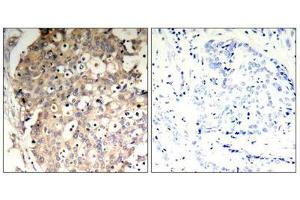 Immunohistochemical analysis of paraffin-embedded human breast carcinoma tissue using SHP-1(Phospho-Tyr536) Antibody(left) or the same antibody preincubated with blocking peptide(right). (SHP1 anticorps  (pTyr536))