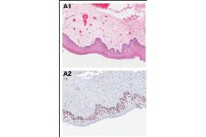 Immunohistochemical analysis of PDCD4 shows the corresponding H&E-stained and PDCD4-stained tissue sections from patients with OSCC. (PDCD4 anticorps  (pSer457))