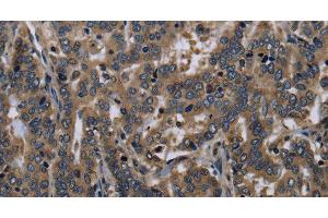 Immunohistochemistry of paraffin-embedded Human liver cancer tissue using FGF18 Polyclonal Antibody at dilution 1:40