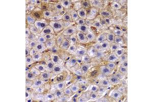 Immunohistochemistry of paraffin-embedded human liver cancer using TCTN3 antibody at dilution of 1:100 (40x lens). (TCTN3 anticorps)