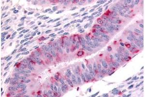 Human Uterus (formalin-fixed, paraffin-embedded) stained with DPP8 antibody ABIN213565 at 20 ug/ml followed by biotinylated goat anti-rabbit IgG secondary antibody ABIN481713, alkaline phosphatase-streptavidin and chromogen.