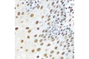 Immunohistochemical analysis of Karyopherin alpha-3 staining in human esophageal cancer formalin fixed paraffin embedded tissue section. (KPNA3 anticorps)