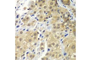 Immunohistochemistry of paraffin-embedded human liver cancer using SGTA antibody.