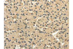 The image on the left is immunohistochemistry of paraffin-embedded Human liver cancer tissue using ABIN7131516(TULP2 Antibody) at dilution 1/20, on the right is treated with fusion protein. (TULP2 anticorps)