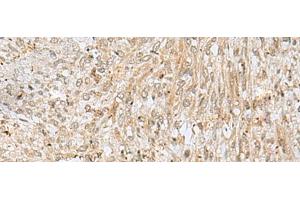 Immunohistochemistry of paraffin-embedded Human liver cancer tissue using NUP58 Polyclonal Antibody at dilution of 1:50(x200) (NUPL1 anticorps)