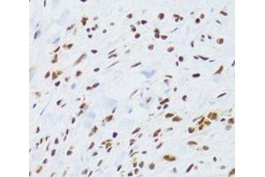 Immunohistochemistry of paraffin-embedded Human gastric cancer using DDB1 Polyclonal Antibody at dilution of 1:100 (40x lens).