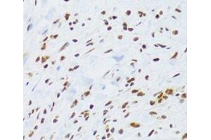 Immunohistochemistry of paraffin-embedded Human gastric cancer using DDB1 Polyclonal Antibody at dilution of 1:100 (40x lens). (DDB1 anticorps)