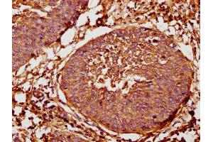 IHC image of ABIN7144329 diluted at 1:400 and staining in paraffin-embedded human cervical cancer performed on a Leica BondTM system. (TAP2 anticorps  (AA 473-615))