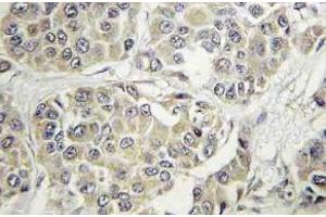 Immunohistochemistry (IHC) analyzes of Tyk 2 antibody in paraffin-embedded human breast carcinoma tissue. (TYK2 anticorps)