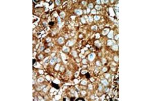 Formalin-fixed and paraffin-embedded human cancer tissue reacted with the primary antibody, which was peroxidase-conjugated to the secondary antibody, followed by AEC staining. (PFKFB3 anticorps  (C-Term))