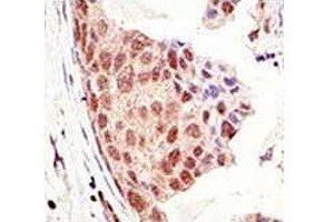 IHC analysis of FFPE human breast carcinoma tissue stained with the SUMO antibody (SUMO1 anticorps  (AA 55-86))