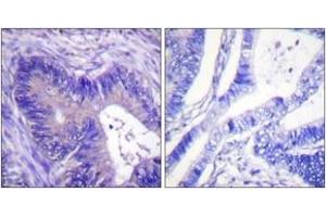 Immunohistochemistry analysis of paraffin-embedded human colon carcinoma, using ATP-Citrate Lyase (Phospho-Ser454) Antibody.
