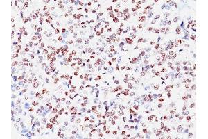 Formalin-fixed, paraffin-embedded human Melanoma stained with MITF Mouse Monoclonal Antibody (SPM290) (MITF anticorps)