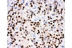 IHC-P: Progesterone Receptor antibody testing of human breast cancer tissue