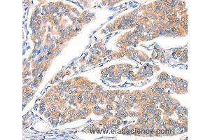 Immunohistochemistry of Human breast cancer using ART4 Polyclonal Antibody at dilution of 1:30 (ART4 anticorps)